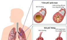 Khống chế đợt cấp của bệnh phổi tắc nghẽn mạn tính