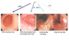 Viêm dạ dày - tá tràng và nhiễm khuẩn Helicobacter pylori