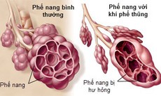 Đặt coil trong phế nang: Giải pháp mới cho người bệnh khí phế thũng