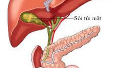 Sỏi túi mật và cách xử trí