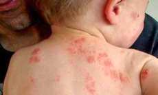  Tìm ra nguyên nhân gây bệnh eczema