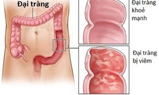 Biểu hiện bệnh đại tràng?