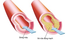 Cách nhìn mới về xơ vữa động mạch