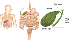 Sỏi mật do đâu mà có?