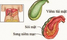 Sỏi mật có nguy hiểm?