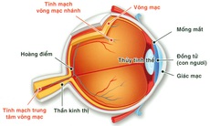 Tắc tĩnh mạch võng mạc do đâu?