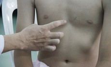 Bệnh lõm ngực bẩm sinh và phương pháp điều trị