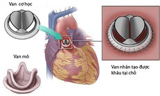 Bệnh van tim - Khi nào cần điều trị?
