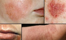 Bệnh eczema có chữa dứt điểm được không?