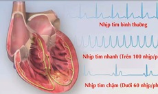 Thiết bị xác định rối loạn nhịp tim