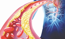 Nguyên nhân tăng mỡ máu