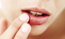 Nẻ môi do thuốc chữa vảy nến, có nên dừng?