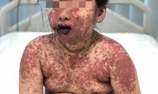 Cứu sống bệnh nhi bị hội chứng Stevens Johnson Syndrome do tự ý sử dụng thuốc