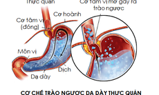 Ðông y chữa viêm thực quản trào ngược