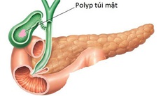 Polyp túi mật, khi nào cần điều trị?