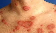 Ðể thoát khỏi vòng xoắn ngứa - gãi - ngứa của viêm da thần kinh
