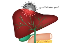 Viêm gan siêu vi C  và các biến chứng  thường gặp