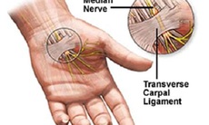 Hội chứng ống cổ tay, cần phát hiện sớm