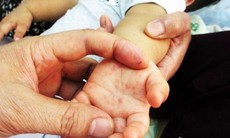 Phòng bệnh tay chân miệng bằng Ðông y