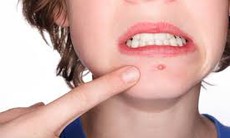 Điều trị bệnh Acne như thế nào?