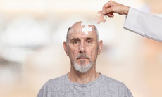 Bệnh Alzheimer phát hiện và điều trị?