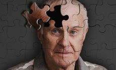 Xác định biến thể gene gây bệnh Alzheimer