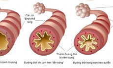 Cách sống chung với hen phế quản