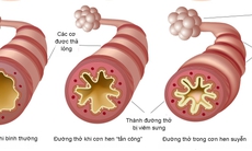 Hen phế quản – cần được điều trị đúng, kiểm soát triệt để