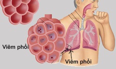 Các bệnh phổi do Lupus ban đỏ