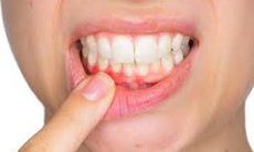 Viêm nướu răng - Chớ coi thường!