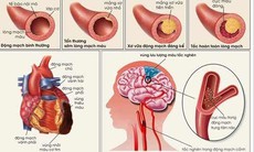 Cách ngừa xơ vữa động mạch