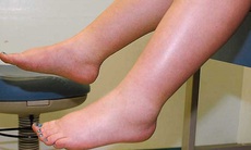 Phù chân ở người cao tuổi có đáng ngại?