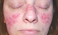 Mẹ bầu mắc lupus ban đỏ dễ gặp nguy cả mẹ lẫn con