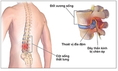 Sai lầm phổ biến có thể gây  bại liệt, tàn phế suốt đời