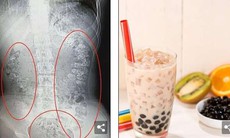 100 hạt trân châu mắc kẹt trong bụng bé gái