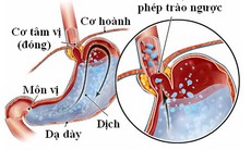 Bài thuốc trị bệnh trào ngược dạ dày thực quản