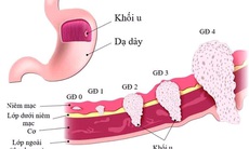Các loại ung thư khó phát hiện sớm