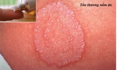 Thuốc trị một số bệnh da hay gặp mùa nắng nóng