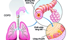 Cần hiểu rõ hơn về bệnh phổi tắc nghẽn mạn tính