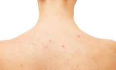 Mụn ở lưng có phải do nóng gan?