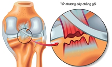 Đứt dây chằng chéo trước gối: Khi nào cần phẫu thuật?