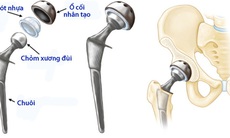 Ðiều cần biết về thay khớp háng