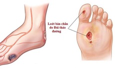 Phòng ngừa biến chứng do đái tháo đường type 1