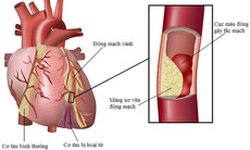 Bệnh mạch vành: Nguy cơ và phòng tránh