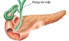 Ðiều trị polyp túi mật