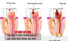 Lấy tủy về răng rất đau