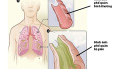 Giãn phế quản: Cách phòng ngừa và chăm sóc