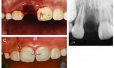 Răng rơi ra khỏi miệng, có gắn lại như cũ được không?