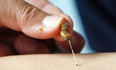 Nhồi máu cơ tim vì bị ong đốt