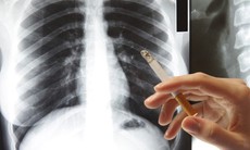 Ðối phó với “tác dụng phụ” sau bỏ thuốc lá